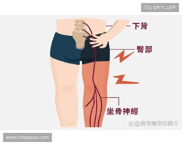 专家解读坐骨神经痛成因及治疗方法大多数患者可避免手术治疗